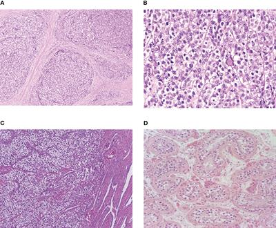 Seminoma and dysgerminoma: evidence for alignment of clinical trials and de-escalation of systemic chemotherapy